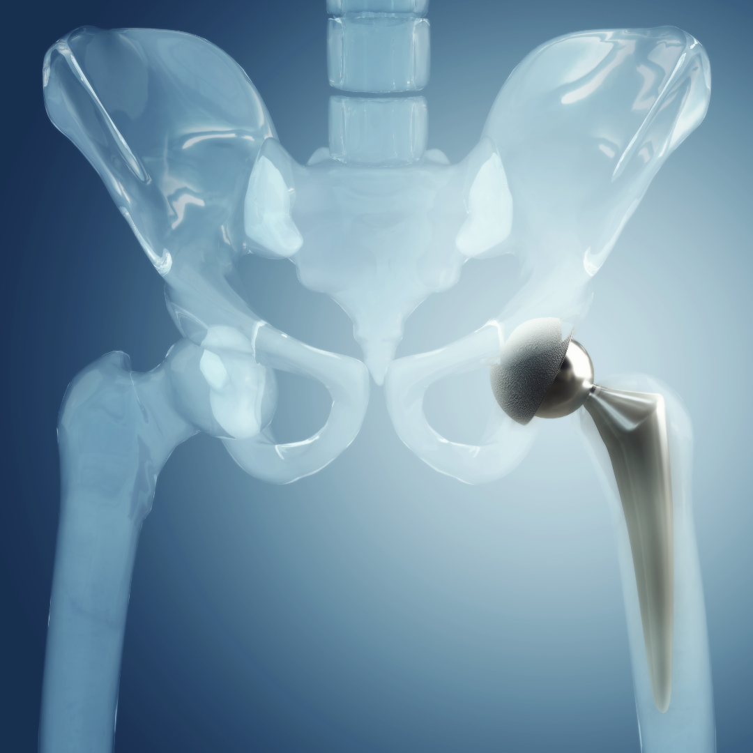 Joint replacement surgery at Suprem Multispeciality Hospital 2